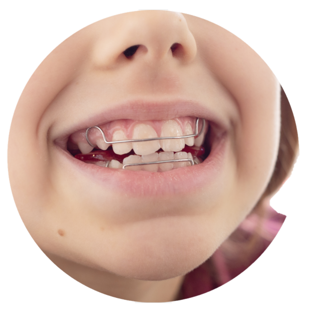 Acquista Bocchino per apparecchi ortodontici per denti da bambino per